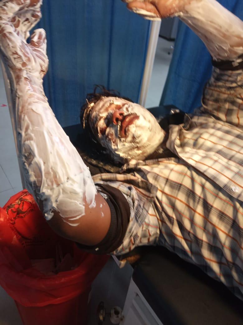 गोमती नगर में दबंगों के हौसले बुलंद डाला खौलता हुआ तेल बदन पर